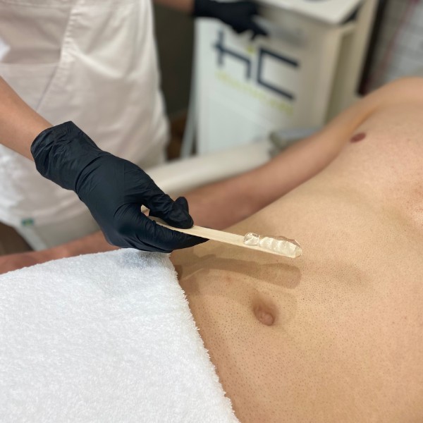 Kriolipoliza PAGANI CRYO T-SHOCK przebieg zabiegu