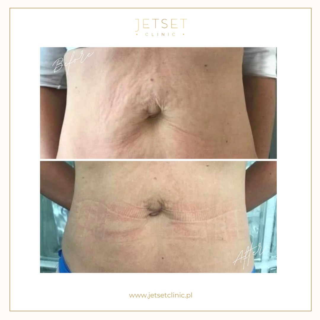 Radiofrekwencja Mikroigłowa SECRET RF Warszawa efekty skóra po ciąży