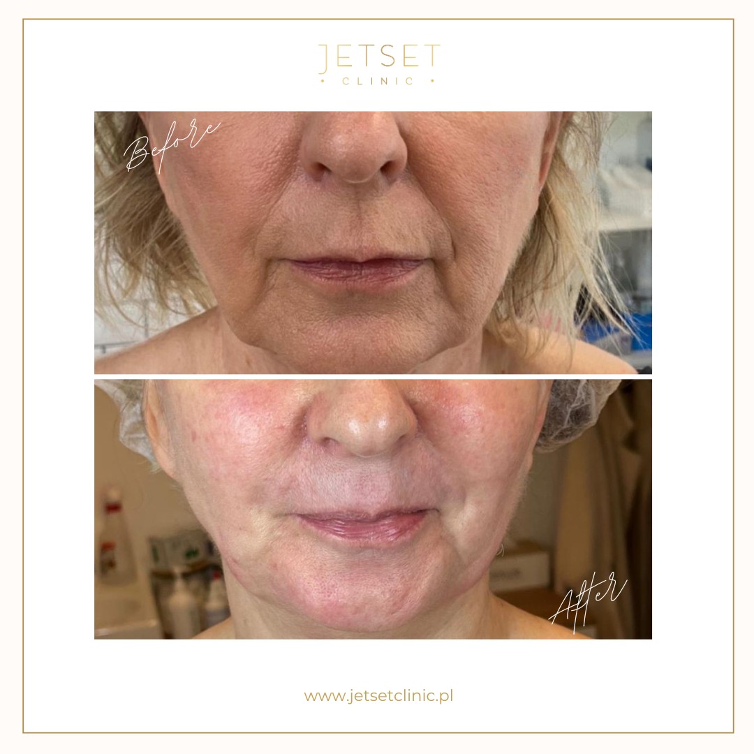 Radiofrekwencja Mikroigłowa SECRET RF Warszawa usuwanie zmarszczek i bruzd