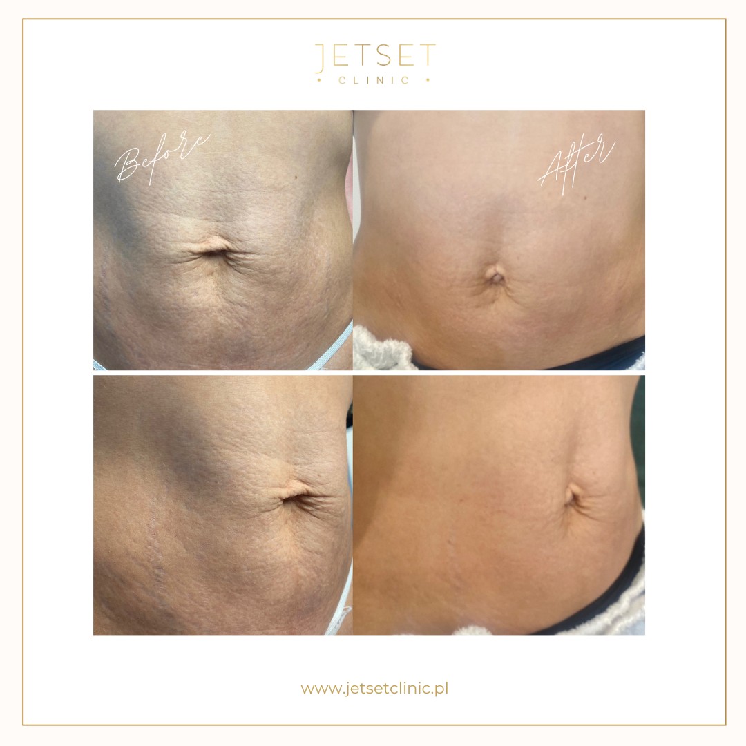Radiofrekwencja Mikroigłowa SECRET RF Warszawa zagęszczenie skóry na brzuchu