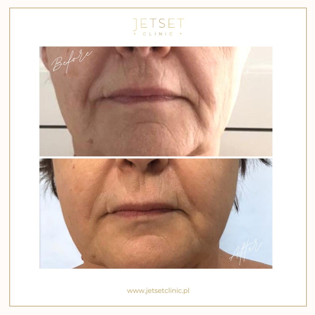 Radiofrekwencja Mikroigłowa SECRET RF Warszawa efekty chomiki